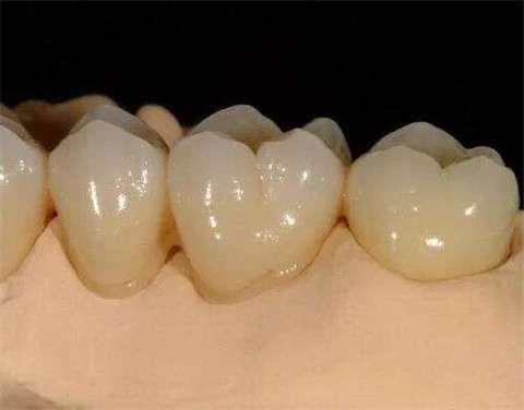 全口保持器是什么？全口保持器对身体有益吗？