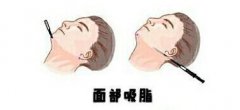 西安热玛吉美容哪家医院好？推荐前五名医院，各有何优势及价格一览