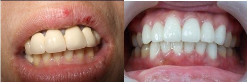 全瓷牙—牙齿缺损爱美者的美牙医生（图）