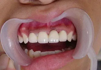 门牙缺损做全瓷牙修复的效果好不好
