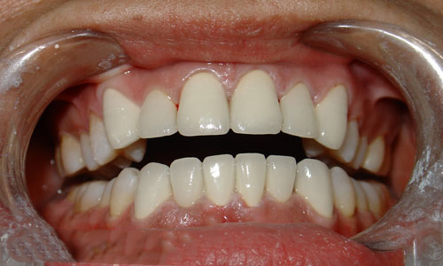 用二氧化锆全瓷牙修复门牙有什么优点