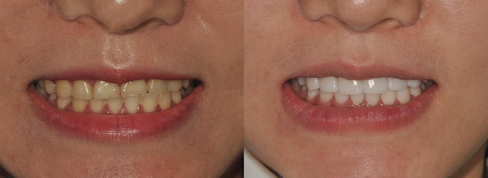 门牙残缺做全瓷牙修复有什么优点