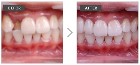 门牙缺损做全瓷牙有哪些好处和优点