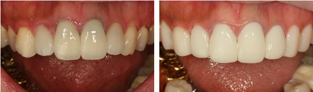 二氧化锆全瓷牙修复缺损门牙后可以嗑瓜子吗