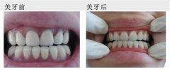 牙齿修复选择二氧化锆全瓷牙有哪些优点