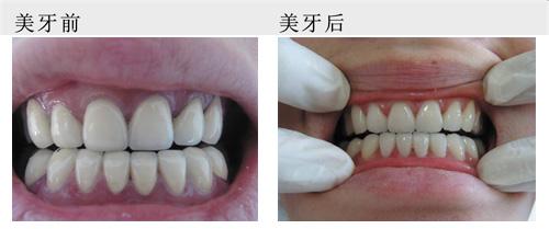 二氧化锆全瓷牙修复缺损门牙的价格是多少