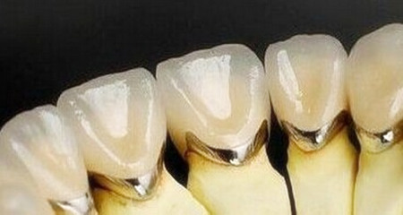 牙齿缺损镶一颗全瓷门牙大概需要多少钱