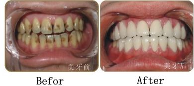 全瓷牙与烤瓷牙的区别表现在哪里