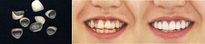 二氧化锆全瓷牙修复牙齿会有缺点吗