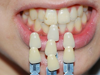 牙齿缺损使用全瓷牙修复的价格一般是多少