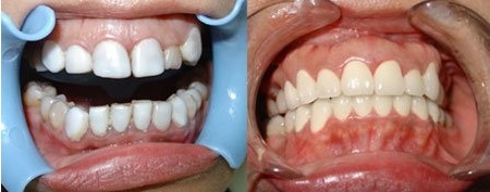 牙齿进行全瓷牙修复一般价格是多少