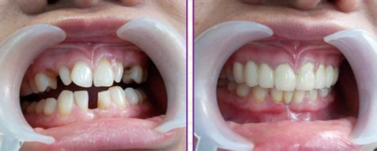 使用二氧化锆全瓷牙来修复牙齿有什么好处