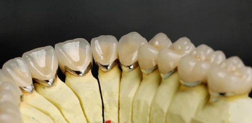 口腔修复做全瓷牙有哪些优点