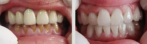 牙齿修复选用二氧化锆全瓷烤瓷牙效果如何