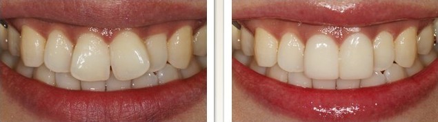 用二氧化锆全瓷牙修复门牙有什么优点