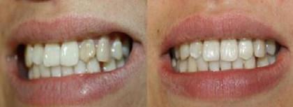 修复断裂的门牙选择二氧化锆全瓷牙效果好吗