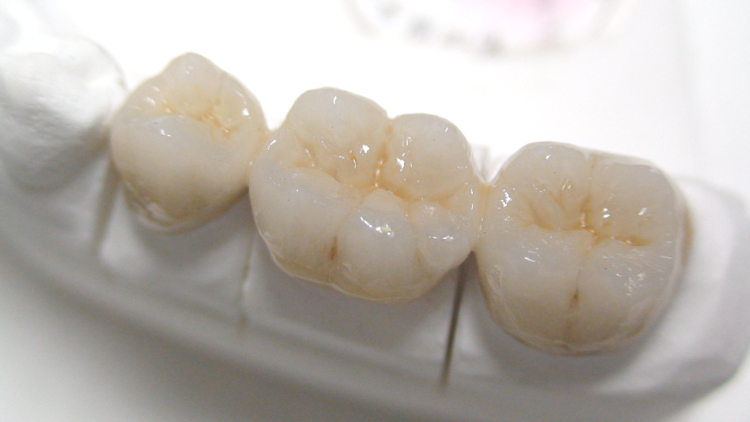 牙齿缺损做全瓷牙要多少钱？