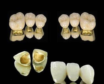 牙齿断裂做全瓷牙修复有哪些优点