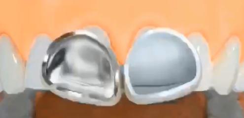 全瓷牙修复 勾勒出较美丽的牙齿（图）