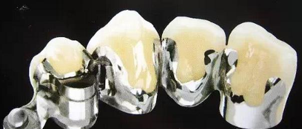 铸瓷冠全瓷牙和二氧化锆全瓷牙哪一种更好