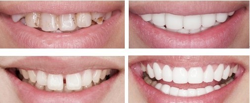 做全瓷牙修复牙齿有什么样的优点