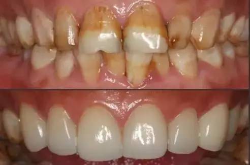 口腔修复做全瓷牙有哪些优点