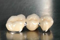 常见的全瓷牙的分类一共有几种？