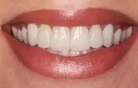 门牙全瓷牙修复的费用是多少