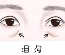 眼周抗衰：嗨体注射填充泪沟效果如何？维持时间及价格解析