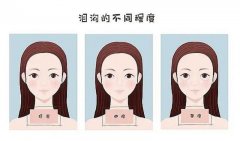 嗨体填充泪沟效果如何？揭秘医美新选择