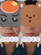 热拉提与热玛吉：美容技术对比及费用解析