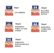 7D聚拉提效果怎么样？费用多少？维持效果有哪些区别？