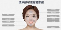 玻尿酸丰耳垂效果如何？费用解析与术后效果评估
