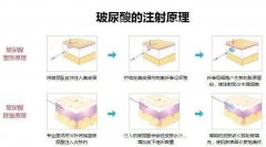 逸美玻尿酸效果如何？价格与持久性全解析