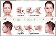 下颌角整形手术：怎么样选择适合自己的方式？