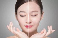 埋线面部除皱：效果、费用及维持时间全解析