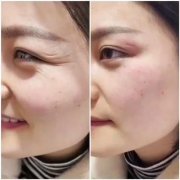 韩式漂唇效果如何？费用多少？