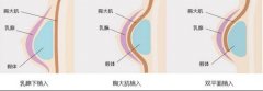 胸部外扩矫正：方法、费用与效果评估