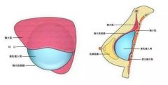 丰胸手术恢复期及费用价格