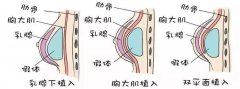自体脂肪丰胸效果及费用解析，哪个方案更合适？