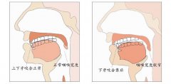 歪鼻矫正手术费用解析及选择指南