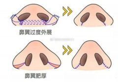 隆鼻手术效果不佳如何进行修复
