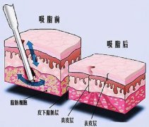 大腿吸脂手术效果如何？专业医院的选择至关重要