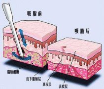 吸脂手术效果不佳怎么办？修复手术费用解析