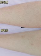 半导体冰点脱毛效果如何？费用多少？维持时间解析