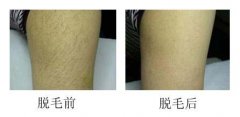 彩光脱毛效果能维持多久？深入解析其持久性与费用