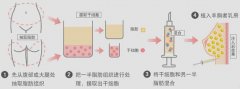 自体脂肪面部填充效果如何？维持时间与费用解析