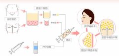 长沙自体脂肪面部填充价格解析及效果评估