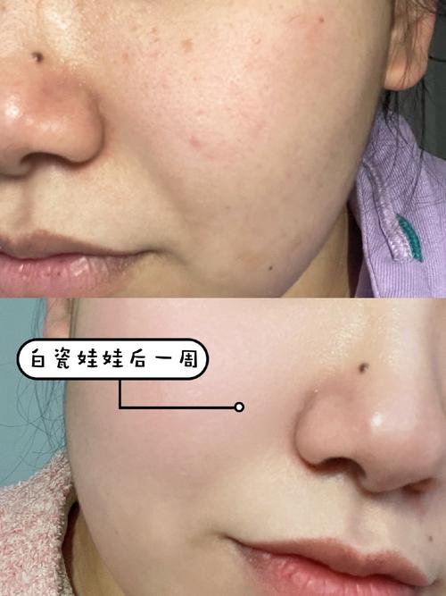 BB光和白瓷娃娃可以交替做吗