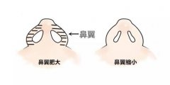 膨体隆鼻假体会容易感染吗？